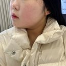 브이투 이경외과의원 | 창원 피부과 인모드리프팅 1회차 내돈내산 후기 , 인모드 전후