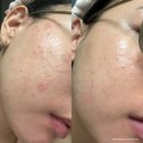 미다올에스테틱 | 광주 첨단 피부관리 도하담에스테틱 4·5회차 솔직 후기