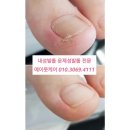 부평 주안 간석동 구월동 송도 연수동 숭의동 내성발톱 문제성손발 전문 #에이풋케어 이미지