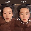 홍우택 | 청담봄온 티타늄리프팅 플러스 전후사진 비교