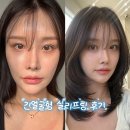 둘소프트 | 잼버실,실루엣소프트 리프팅 긴얼굴후기 (멍,통증,유지기간)