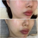 구미 봉곡동 피부관리 클라라뷰티 부작용없는 스킨플래닝 후기