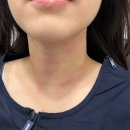 (주)엔터리얼 | 부천 상동 편평사마귀 제거 후기 얼굴부터 쇄골까지 받아본 리얼 경험