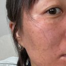 유로미피부비뇨기과 | 선릉 | 힐비뇨기과 잡티제거 성지