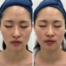 오밀크대전 | 대전 슈퍼젝션 전문점 프리시엘스킨 신상 장비 리프팅 관리 후기