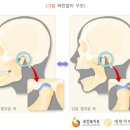 턱관절에 소리 나는 여시가 알려주는 턱관절 전문 치과 후기 (+ 찜질방법 추가 / 찜질시 수분기가 있는 걸로!) 이미지