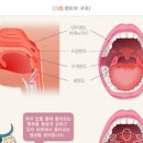 편도염 급성 만성 세균성 원인 열 전염 약 및 아이스크림 이 있을지 이미지