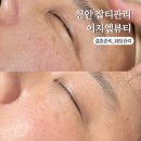 천안 피부관리 편평사마귀 기미 점제거 이지엘뷰티 멜라리티 잡티리무버 추천 후기