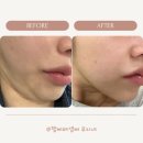 청담 피부과 턱선리프팅 리프테라+실루엣소프트로 이중턱 박살내기(효과,통증,멍,붓기)