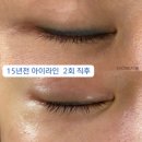 [뷰티/일산] 노데미지 아이라인제거 2회차 내돈내산 후기 : 율스킨스토리