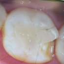 햇살가득치과교정과치과의원 | 은평 서울에스치과의원 치아(이)나 기존 인레이 깨졌을 때 대처법과 크라운 씌우기 1주차 후기 및 비용