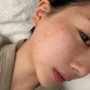 힐스킨피부과의원 네이버블로그