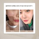 (서울) 홍대피부과 쥬베룩스킨부스터 맞고 효과 본 찐 후기!