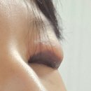 씨유 신기부은점 | 왕 두꺼운 아이라이너 문신제거 후기1차(저도 했습니다)