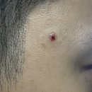 [주엽톡스앤필의원] 사마귀 제거 후 일주일 후기, 제거비용 만족도 후기