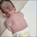8개월 아기 비정형 가와사키 증상 + 장알균 엔테로코커스 균혈증 + 방광요관역류 3등급