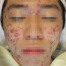 남성약초 | 서면 여드름 흉터 치료 잘하는 곳? 귤껍질 피부였던 30대 남성 <실제 추천 후기>