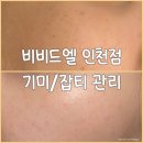 시티프라자약국 | 검단 기미 피부관리 비비드엘 잡티 제거 일주일 후 솔직 후기 / 관리 꿀팁