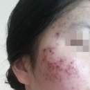 피부과 여드름 압출 후기 성공했던 이유 알려드림