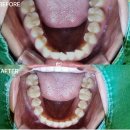 향남이플란트치과의원 | 향남치과추천 5개월 만에 삐뚤한 치아 교정 전•후 차이