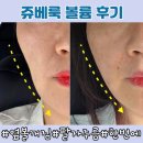 수원동탄피부과 쥬베룩볼륨 리볼르 추천,옆볼패임+팔자주름 채운 솔직 후기