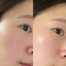 팔자주름 앰플 추천 바르는 필러 화성인 PLLA 플라필스 링클프리 앰플 | 아프지말고 바르자
