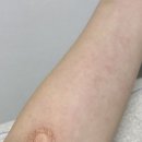 365굿이브닝의원 | 118종 알레르기 검사 마스트 MAST 검사 비용 결과 (Feat.365굿이브닝의원)