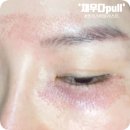 순천피부관리 :: &#39;채우다pull&#39; 플라즈마 블라스트 받아본 후기~