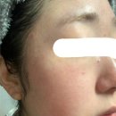 제산한의원 | 주사피부염 한의원 치료 후 홍조도 좋아졌어요.