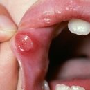 재발성 아프타성 구내염[Recurrent aphthous stomatitis] 이미지