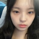 [압구정 POP성형외과] 눈 성형 후기 - 매몰 쌍수 일주일차 붓기