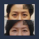 최해천성형외과의원 | 하안검수술 잘하는곳 후기를 보면 알 수 있죠~![가인성형외과]
