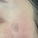 엑셀브이의원 | 5회차] 피코줌 흑자제거+ 레이저토닝 + 엑셀브이 + 백옥주사 후기 l 안산 데이즈 피부과 추천 내돈내산