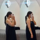 천안 팔뚝 지방추출주사 당일후기 가격 멍 통증 일상생활