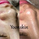 Yoonskin | [윤스킨] 블랙헤드 관리 코피지 관리 후기