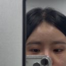 서클 | 눈밑지방재배치잘하는병원 비절개 레이저+다크서클필러 내돈내산 후기