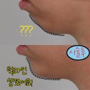 서울美성형외과 | 무턱개선, 턱끝필러 하나로 달라지는 얼굴 비율과 인상 변화