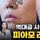 드네의원 | 리프팅 효과·통증·지속기간 총정리｜잔주름·이중턱·팔자주름 개선 후기｜의사 답변｜압구정 드네의원