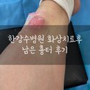 한강수병원 | 한강수병원 화상 칼로덤 사용 치료과정/ 후기 (사진 주의)
