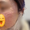 제너리스의원 | 리쥬란 HB 플러스 후기. 연신내 제너리스 의원 ✨. NFC 태그 정품 인증 포인트 적립까지.