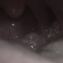 파란이비인후과의원 | 편도 제거술 후기(3cm 혹)