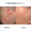 은평구 모공흉터관리 어디서 받아? 이지뷰티랩 콜드플라즈마 받고 피부 자신감 되찾음