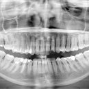 치과 의료장비 파노라마 X-Ray 이미지