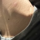 참조은피부과의원 | 서면피부과 밴스의원 남자 점 제거 솔직 후기쓰