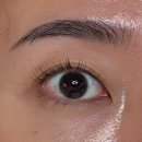 대구수지 | 수지 눈 점 결막모반 제거 ! 대구 안과 레이저 내돈내산 후기! 실비 &amp; 비용 ?