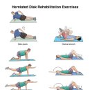 Herniated Disk Rehabilitation Exercises 이미지