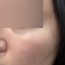 후즈후피부과의원 | [Beauty] :: 신논현피부과 스킨부스터 필로드 예쁨주의쁨의원 강남본점 후기