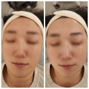 철산피부과 하라힐즈 피부관리 후기