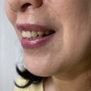 엄마 라미네이트 2차 후기