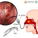 비강암 / 부비동암 (Nasal Cavity Cancer) 이미지